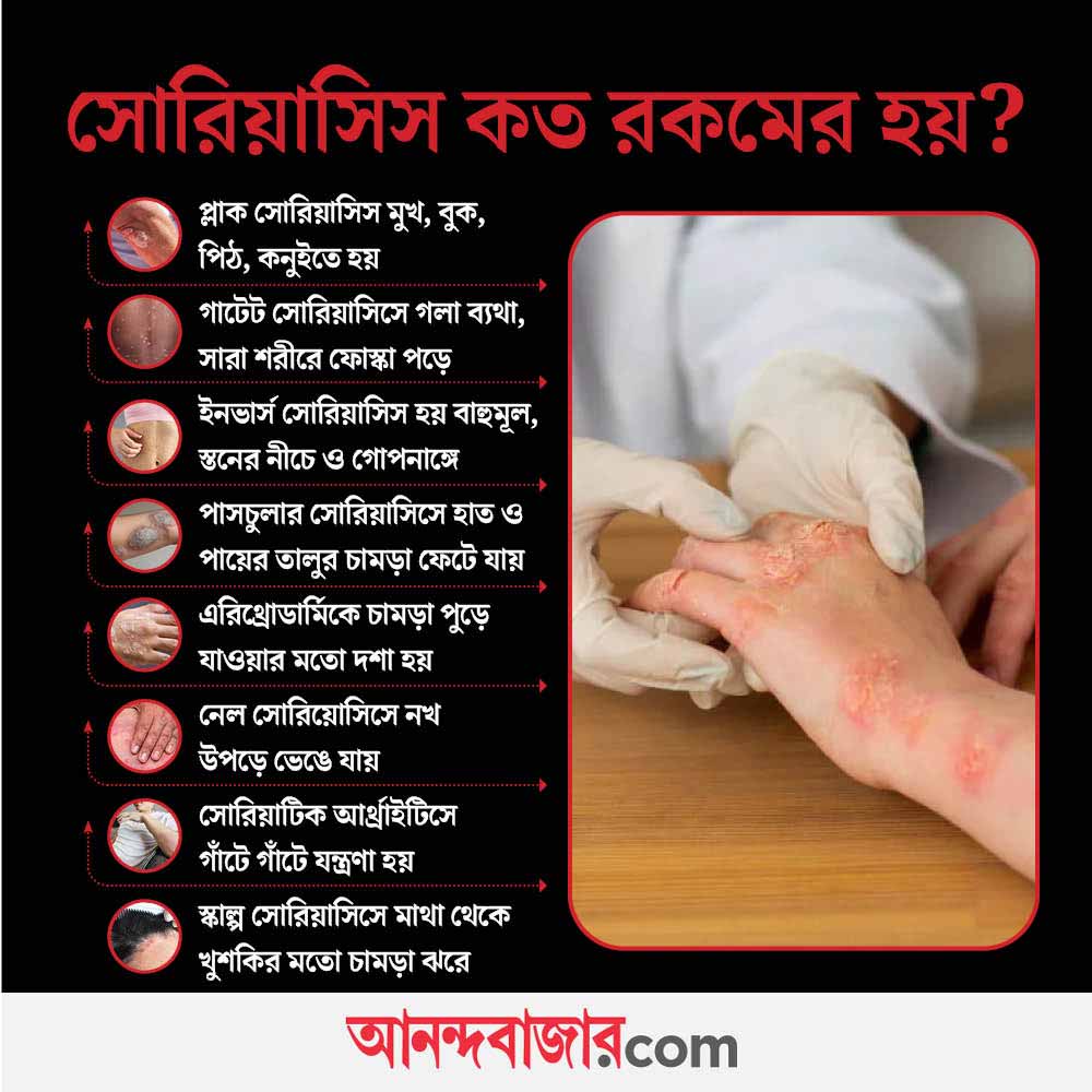 সোরিয়াসিসের নানা ধরন। 