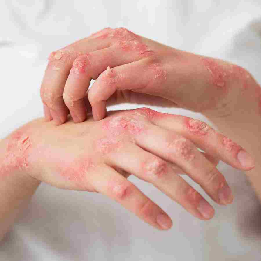 সোরিয়াসিসের নানা রকম চিকিৎসাপদ্ধতি চলে এসেছে এখন।