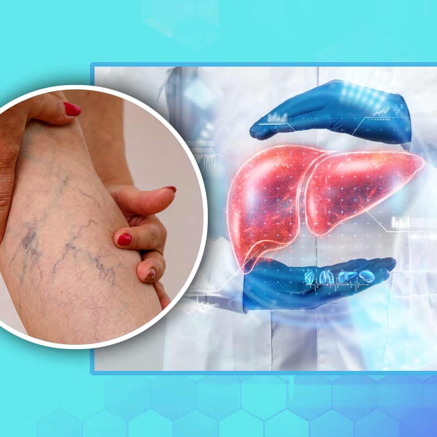 Here are some signs of skin changes that may be liver-related