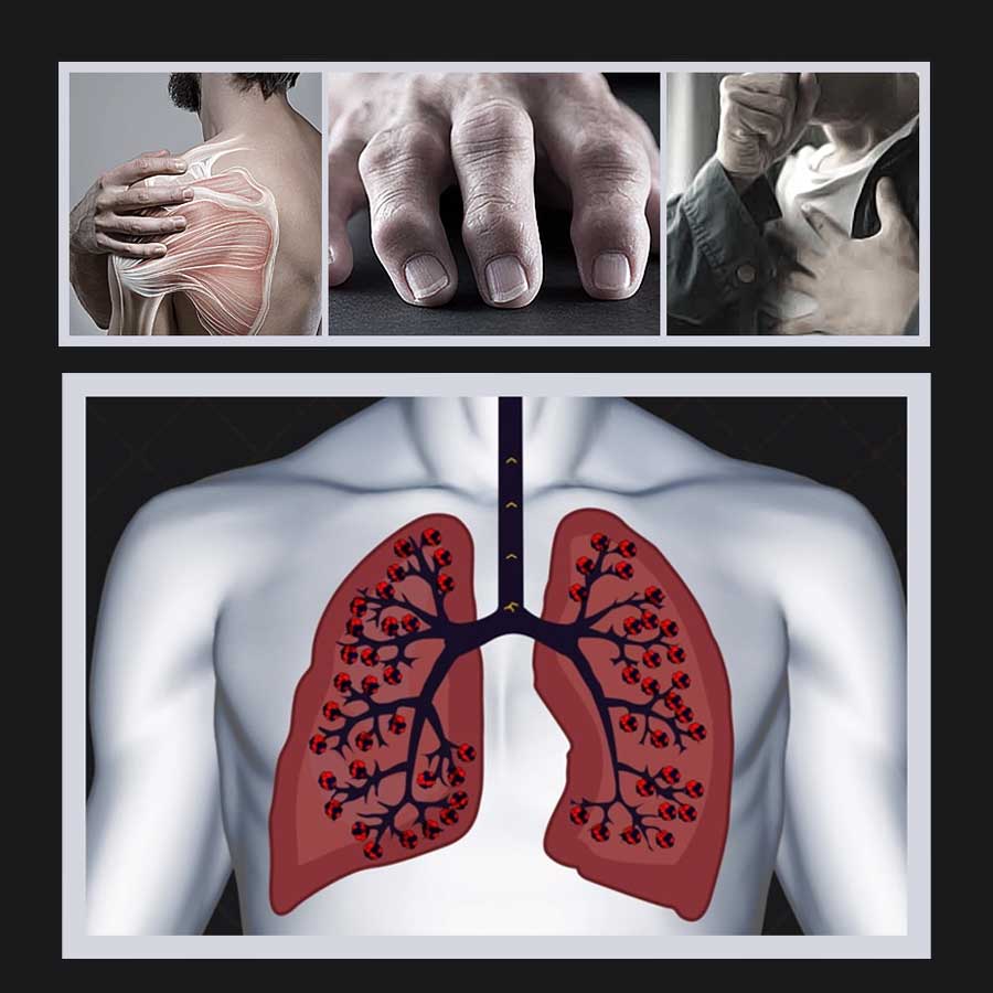 Here are some lesser-known symptoms like fatigue and chest infection you should not ignore in Lung Cancer