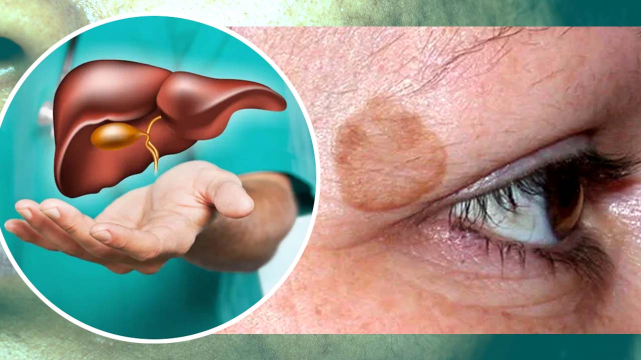 ‘লিভার স্পট’ আদতে কী?