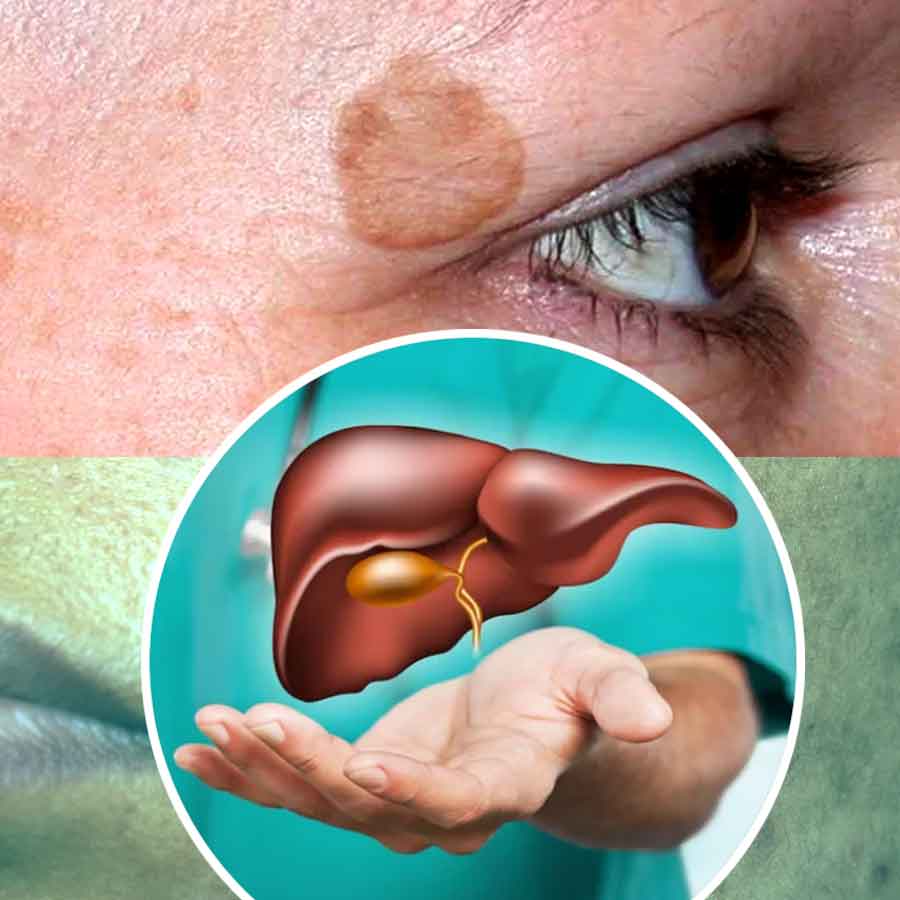 ‘লিভার স্পট’ আদতে কী?