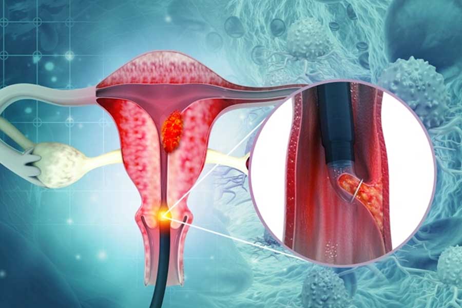 জরায়ুমুখের ক্যানসার।