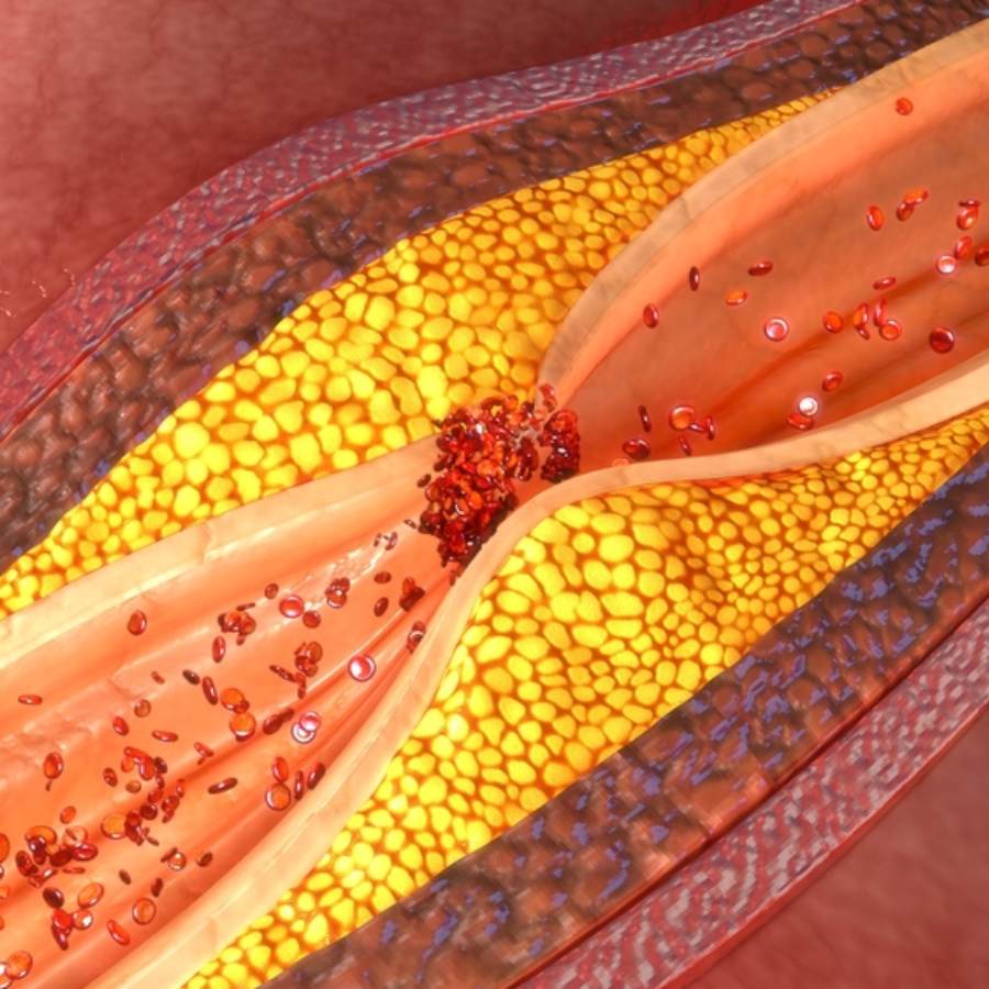 How do two types of arterial plaques soft and hard cause disease like heart attack dgtl