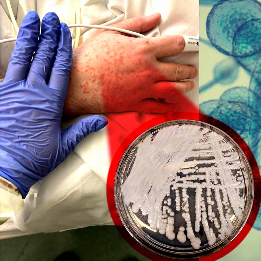 Deadly drug-resistant fungus Candida spreading very rapidly