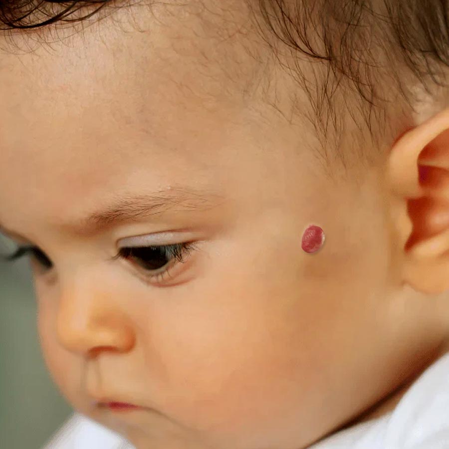 What is Hemangeoma and know its symptoms dgtl