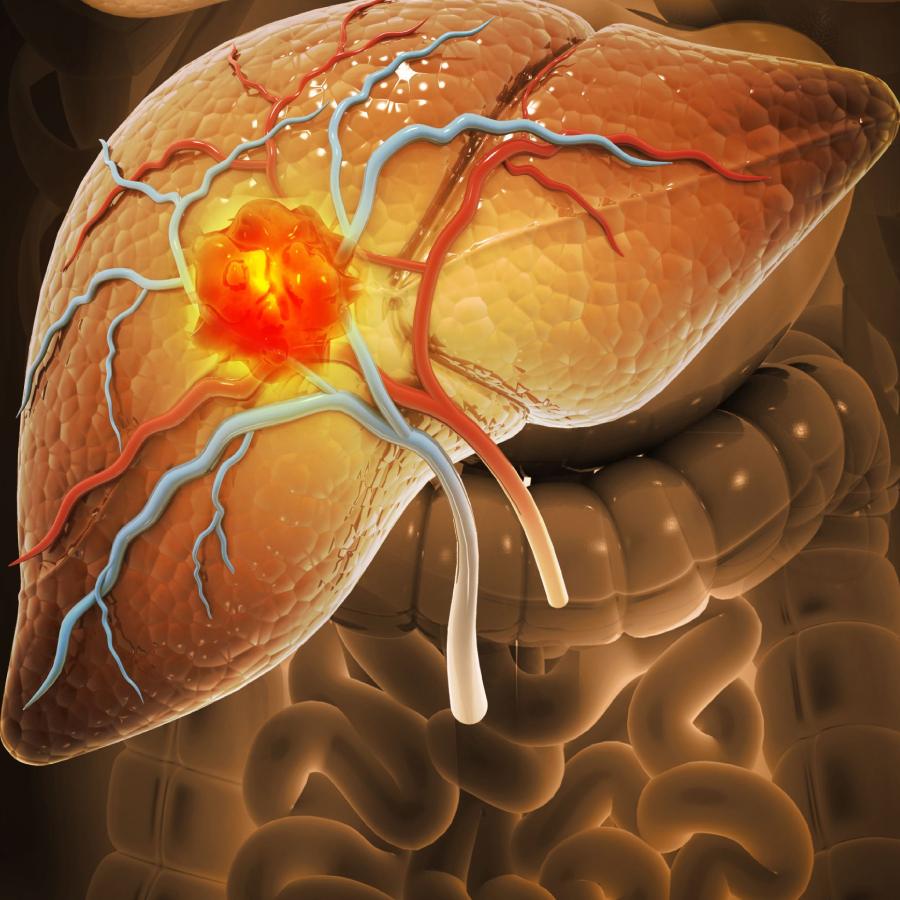 ফ্যাটি লিভার থেকে ক্যানসারের ঝুঁকি।