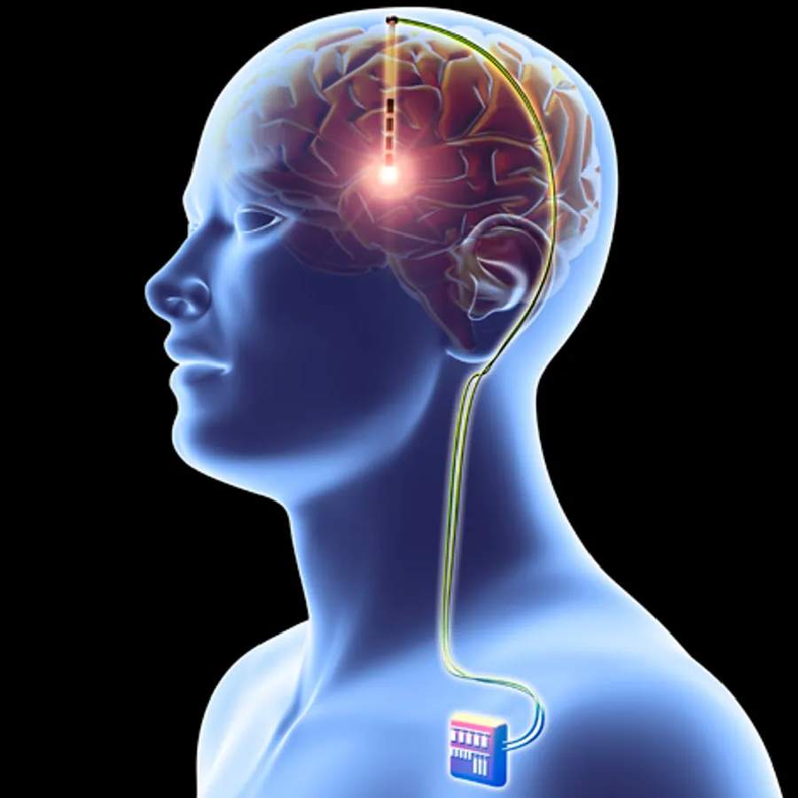 কী ভাবে কাজ করে মস্তিষ্কের পেসমেকার?