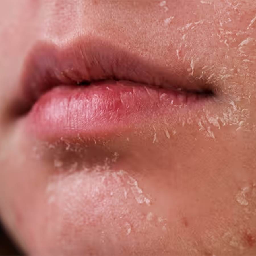 what can you do to prevent peeling dry skin from face dgtl