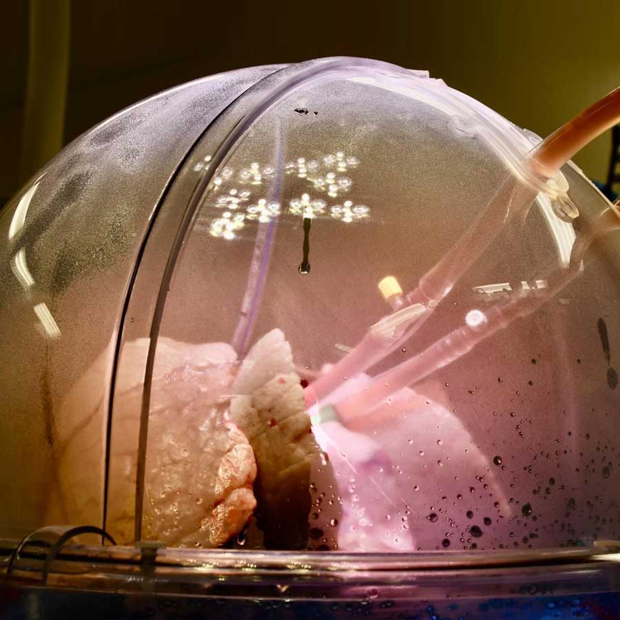 Indian doctor invent Artificial Lung system to keep patient alive for 48 hours