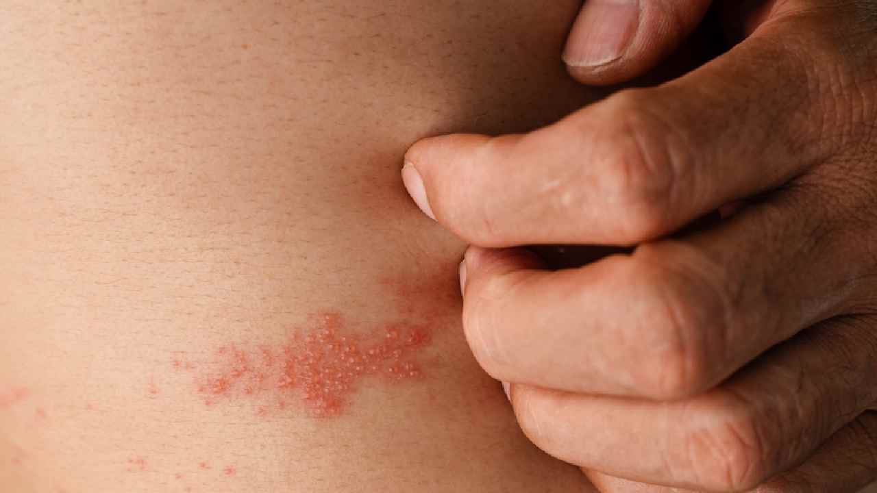 Symptoms of herpes zoster disease one should not ignore dgtl