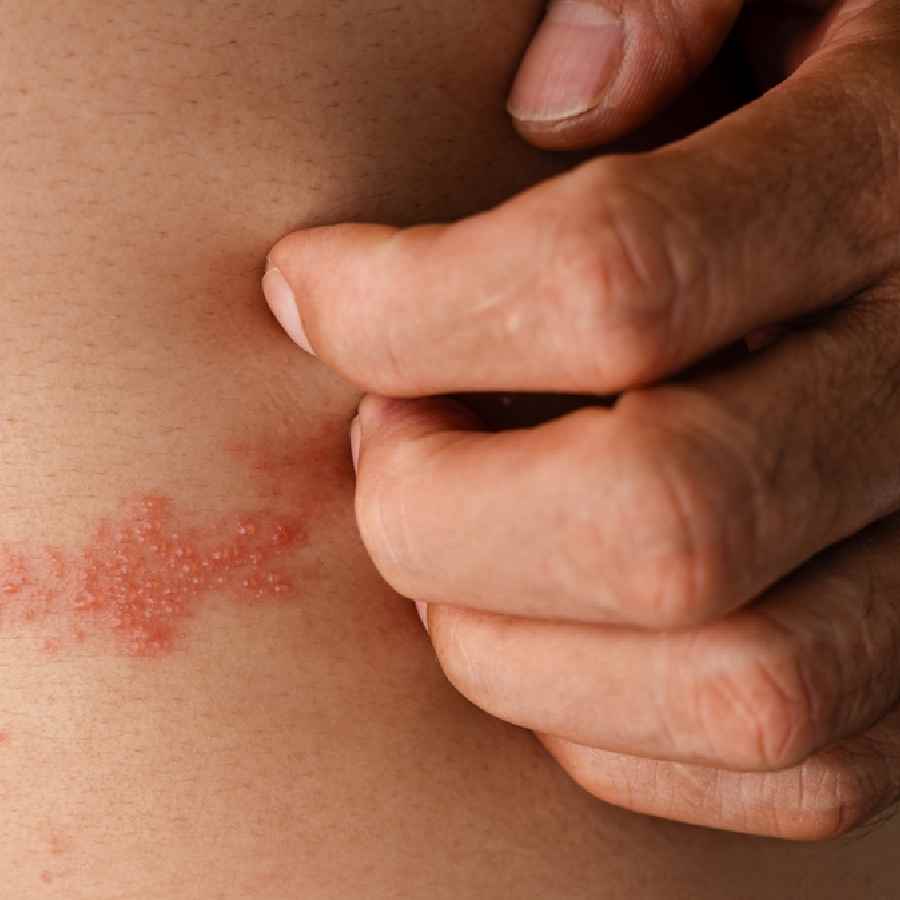 Symptoms of herpes zoster disease one should not ignore dgtl