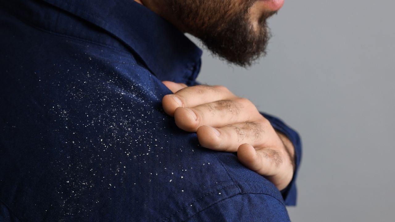 খুশকির সমস্যা থাকলে কোন তেল ব্যবহার করবেন না?