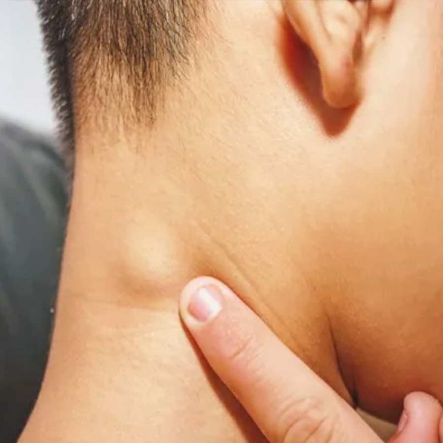 ক্যানসার জয় করলেও পরে ‘ভিটিলিগো’ বা শ্বেতি রোগে আক্রান্ত হন মমতা মোহনদাস। এটি একটি ‘অটোইমিউন ডিজ়অর্ডার’। ত্বকের রং তৈরি করতে সাহায্য করে মেলানোসাইট কোষে থাকা মেলানিন নামক রঞ্জক। নানা শারীরিক সমস্যার কারণে শরীরের রোগ প্রতিরোধ শক্তি শত্রু মনে করে ধ্বংস করতে থাকে ত্বকের রং তৈরি করতে সহায়ক এই কোষগুলিকে। ফলে ত্বক তার স্বাভাবিক রং হারাতে থাকে। ত্বকে সাদাটে ছোপ পড়তে থাকে। একেই বলে শ্বেতি। 