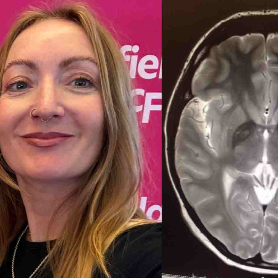 UK Woman Diagnosed With 38 Brain Parasites After India Trip, Symptoms Explained
