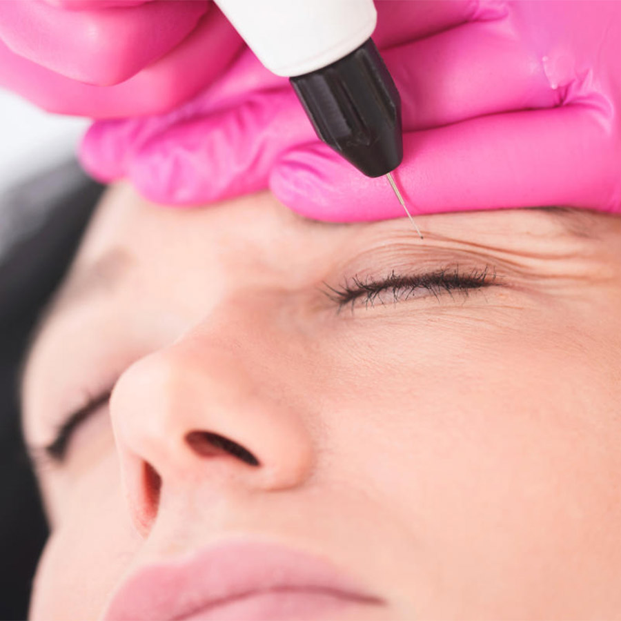 Cholesterol deposits on the eyelids are medically known as xanthelasma which often serve as visible warning signs of deeper health problems