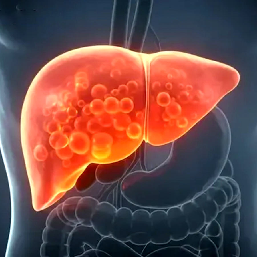 Choline deficiency can cause the liver to store excess fat and raise fatty liver risk
