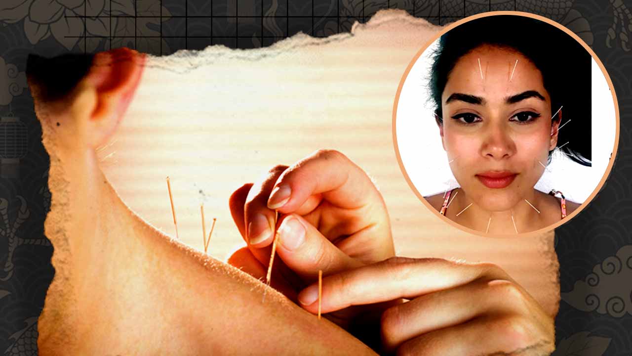 From Mira Rajput’s Glow to Kolkata’s Heritage, how Bengal First Recognized the ancient Acupuncture therapy