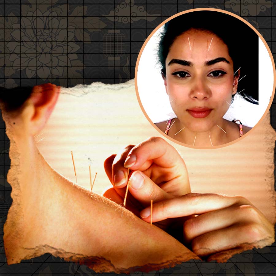 From Mira Rajput’s Glow to Kolkata’s Heritage, how Bengal First Recognized the ancient Acupuncture therapy