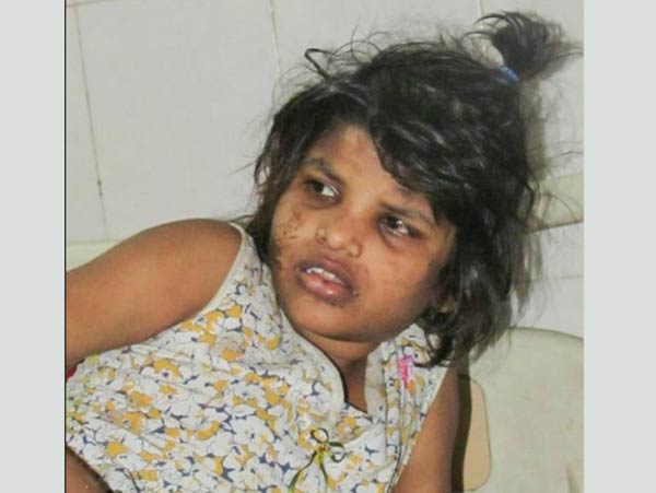 All need to know about Mowgli Girl who has been found in forest in 2017 and dies at 18 in Lucknow after years of rehabilitation