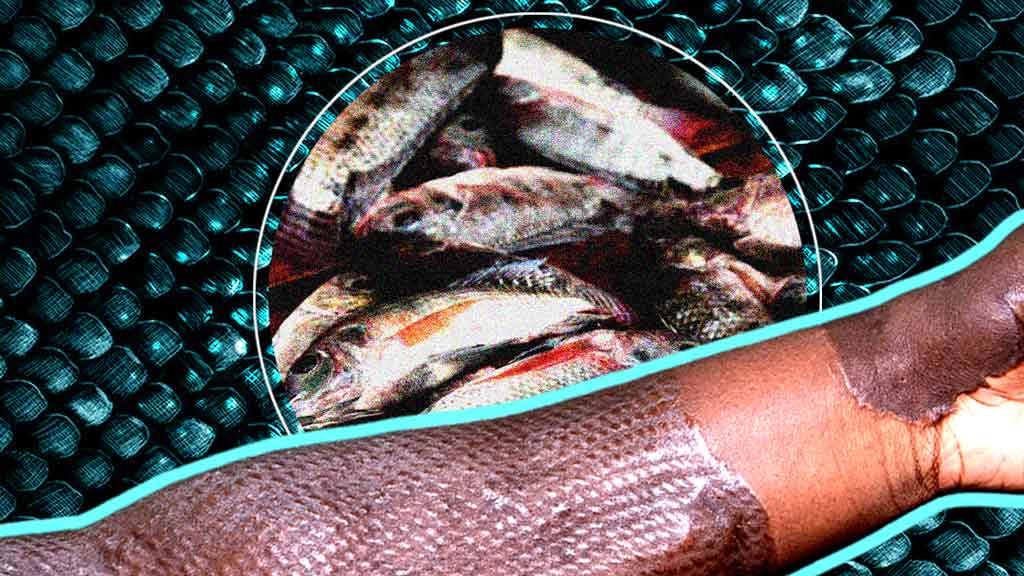 How Tilapia fish skin is currently being studied and used in Brazil for Burn Injuries