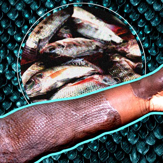 How Tilapia fish skin is currently being studied and used in Brazil for Burn Injuries