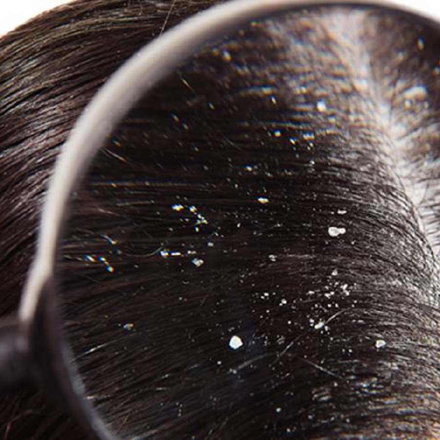 How to Choose the Right Anti-Dandruff Shampoo for Rainy Season Hair Problems dgtl