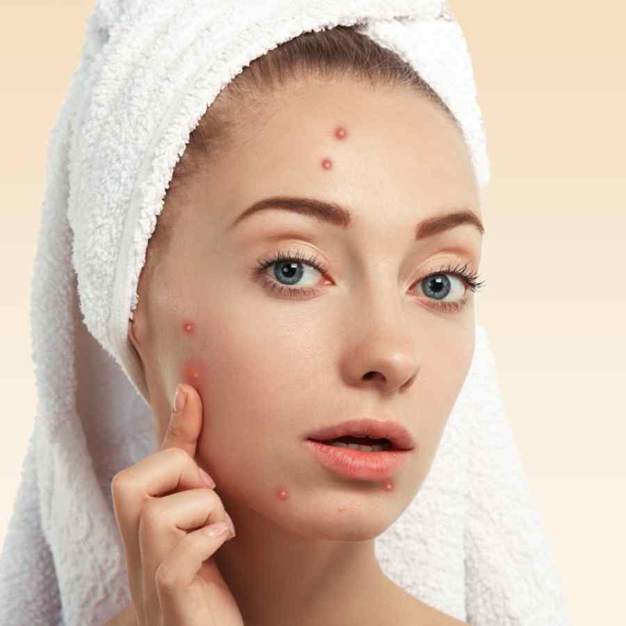 Acne vs Skin Cyst, what is the Difference and how to protect your Skin