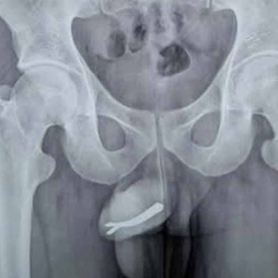 Hair Pins Stuck into Urethra