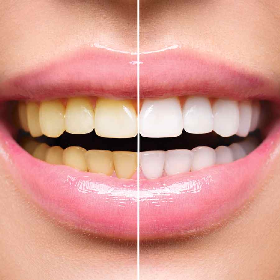 Charcoal, baking soda, purple toothpaste — which whitening hacks actually work