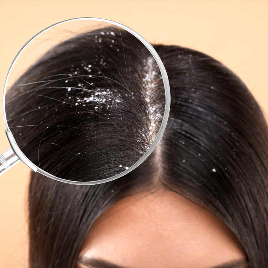 Why Dandruff Keeps Coming Back permanent cure dgtl