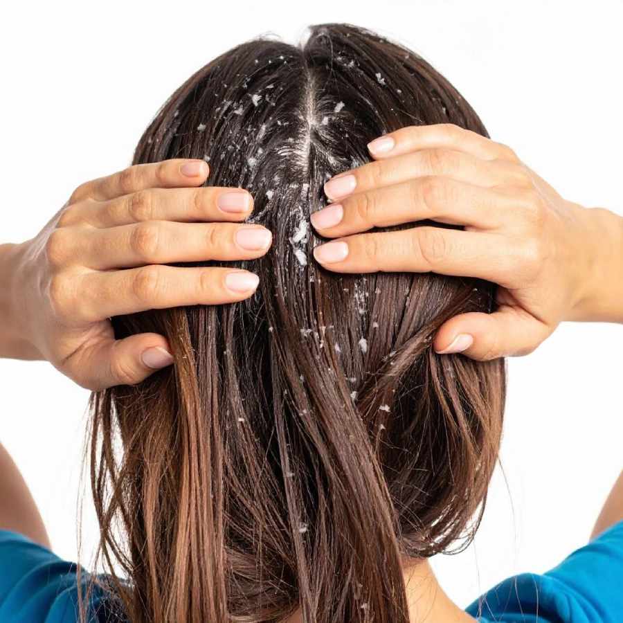 Why Dandruff Keeps Coming Back permanent cure dgtl