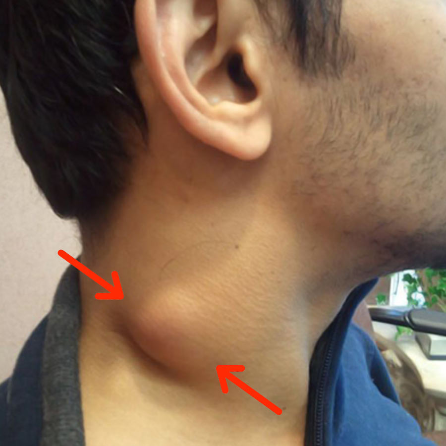 Is a Lump on the Back of the Neck Always Cancer, Signs You Should Not Ignore Dgtl