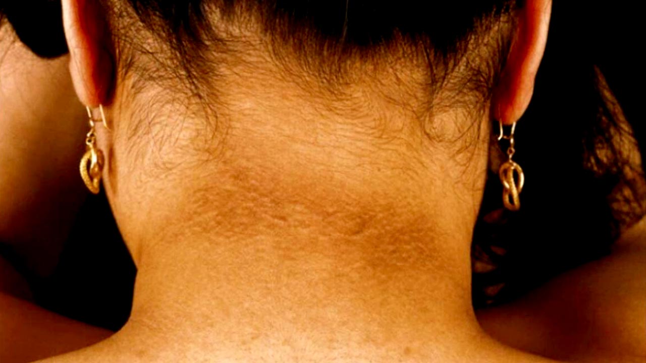 ঘাড়ের কাছে কালচে দাগ দেখে কেন সতর্ক হতে হবে?