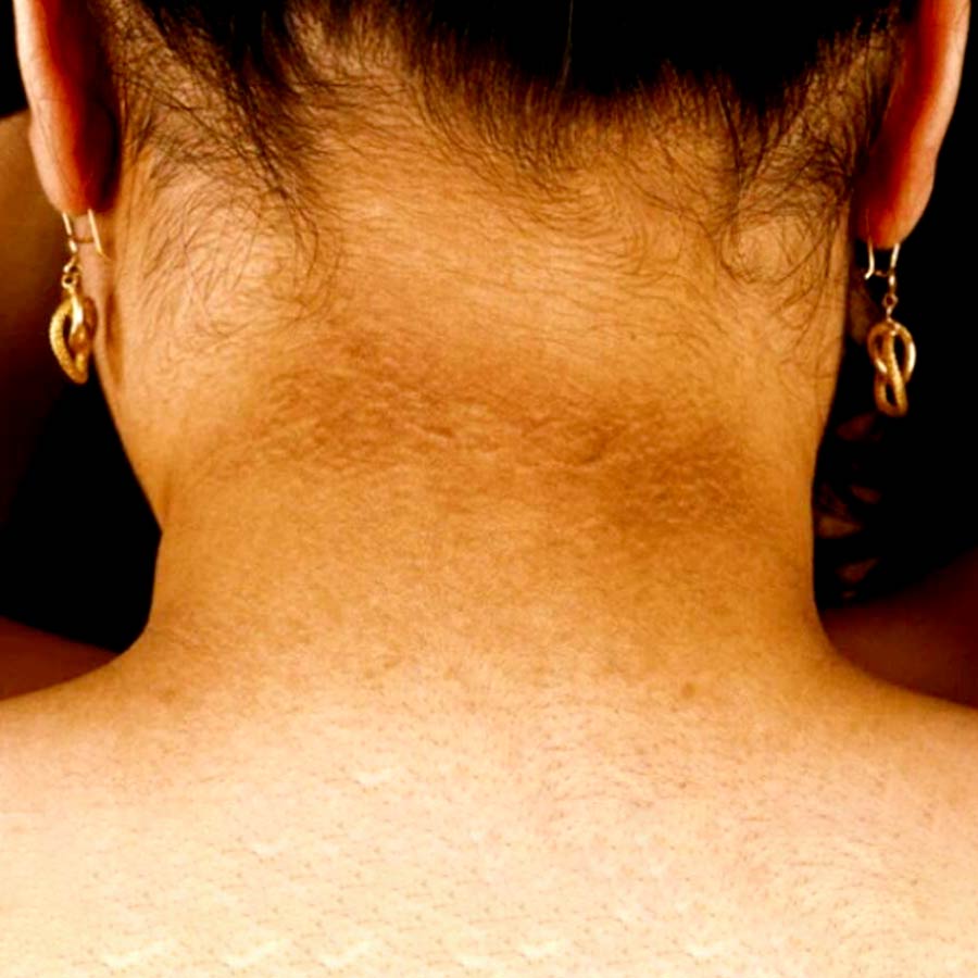 This is not hygiene issue, know why some have dark and velvety skin in neck and underarms dgtl