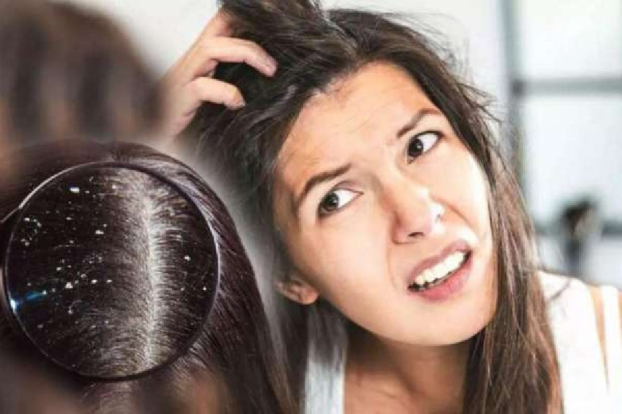 how to oil your hair in monsoon if you have dandruff problem dgtl
