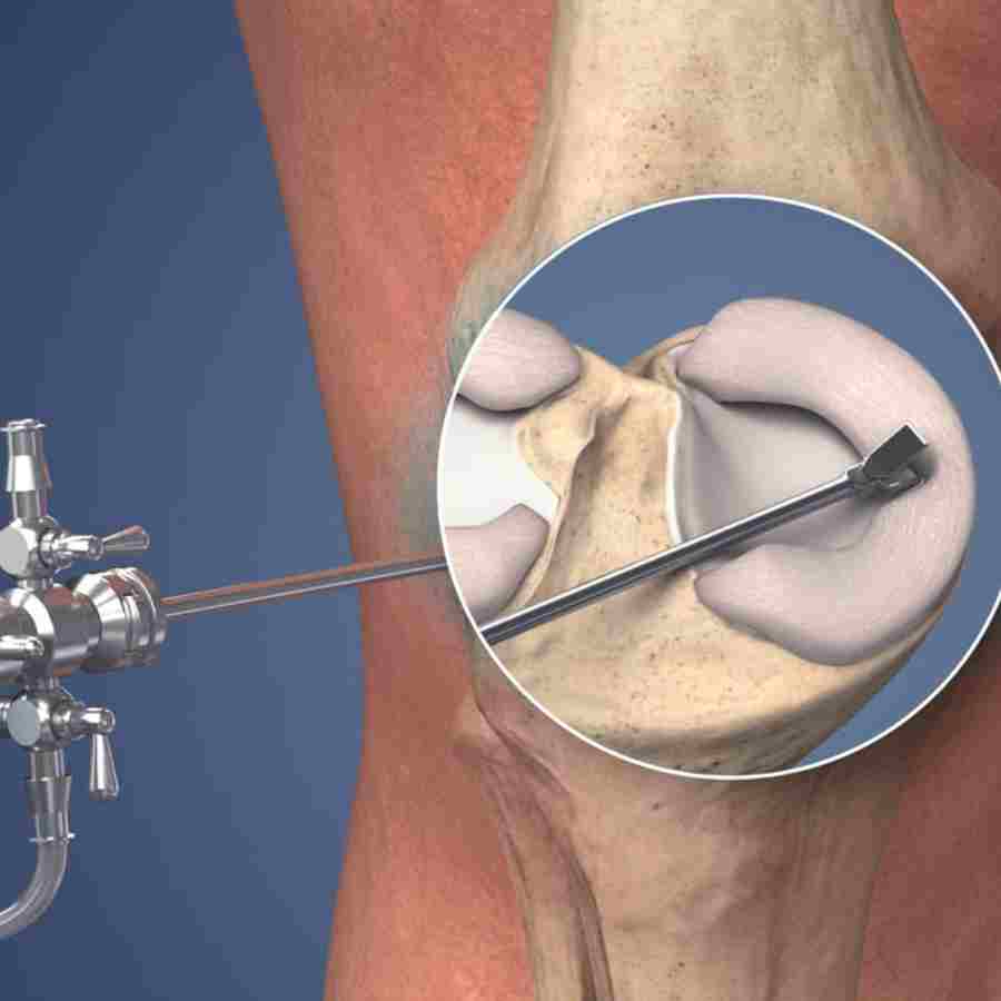 What Is Arthroscopy, What are the risks and benefits of this surgery