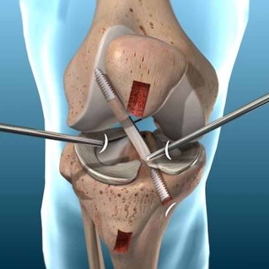 What Is Arthroscopy, What are the risks and benefits of this surgery
