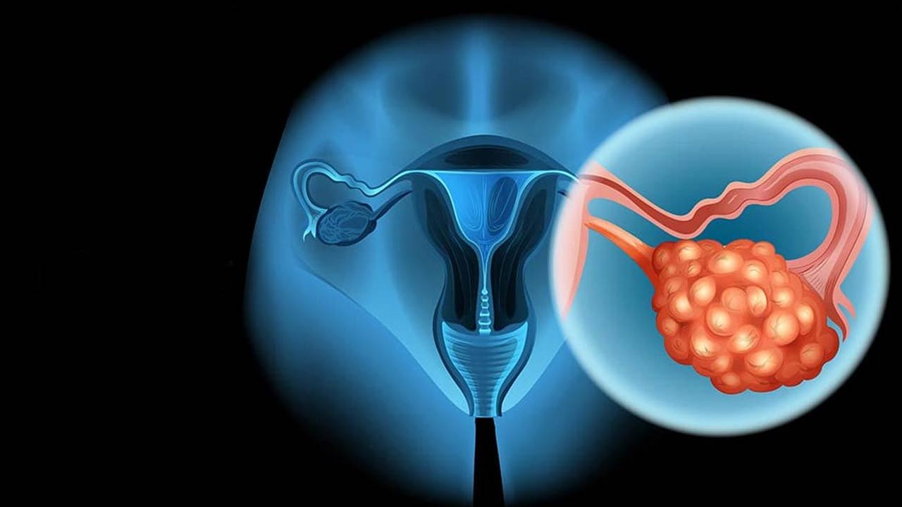 Is ovarian cancer hereditary, how to detect