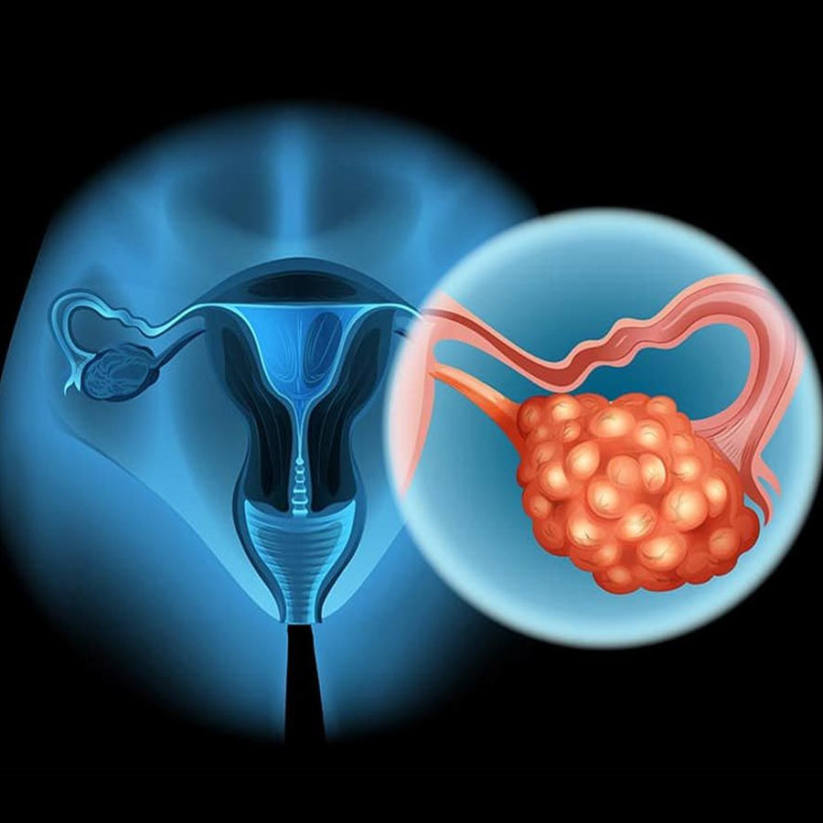 Is ovarian cancer hereditary, how to detect
