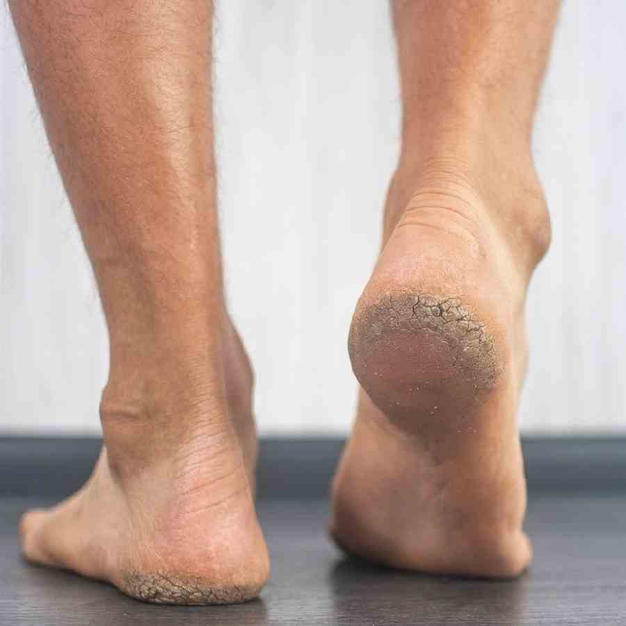 পা ফাটার সমস্যায় ভোগান্তি বাড়ছে?