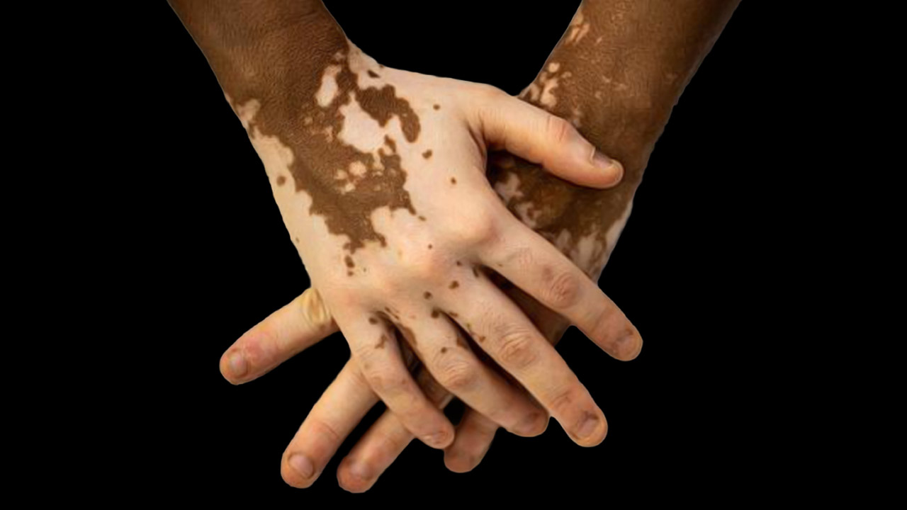 শ্বেতির কি কোনও চিকিৎসা আছে?