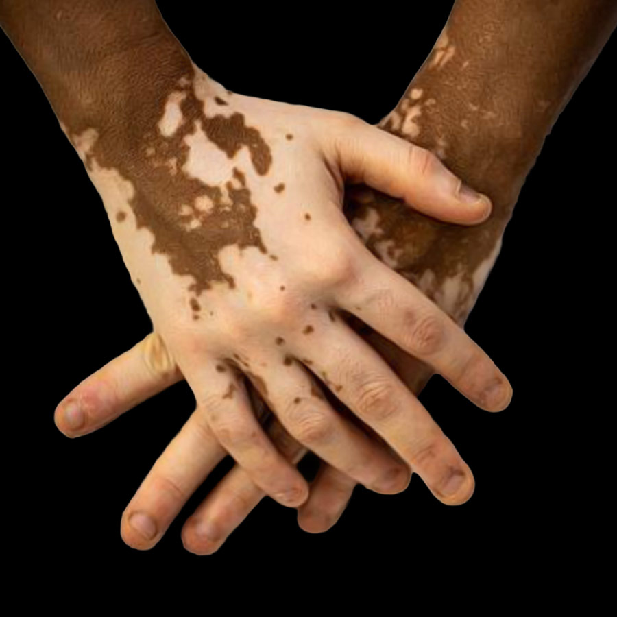 শ্বেতির কি কোনও চিকিৎসা আছে?