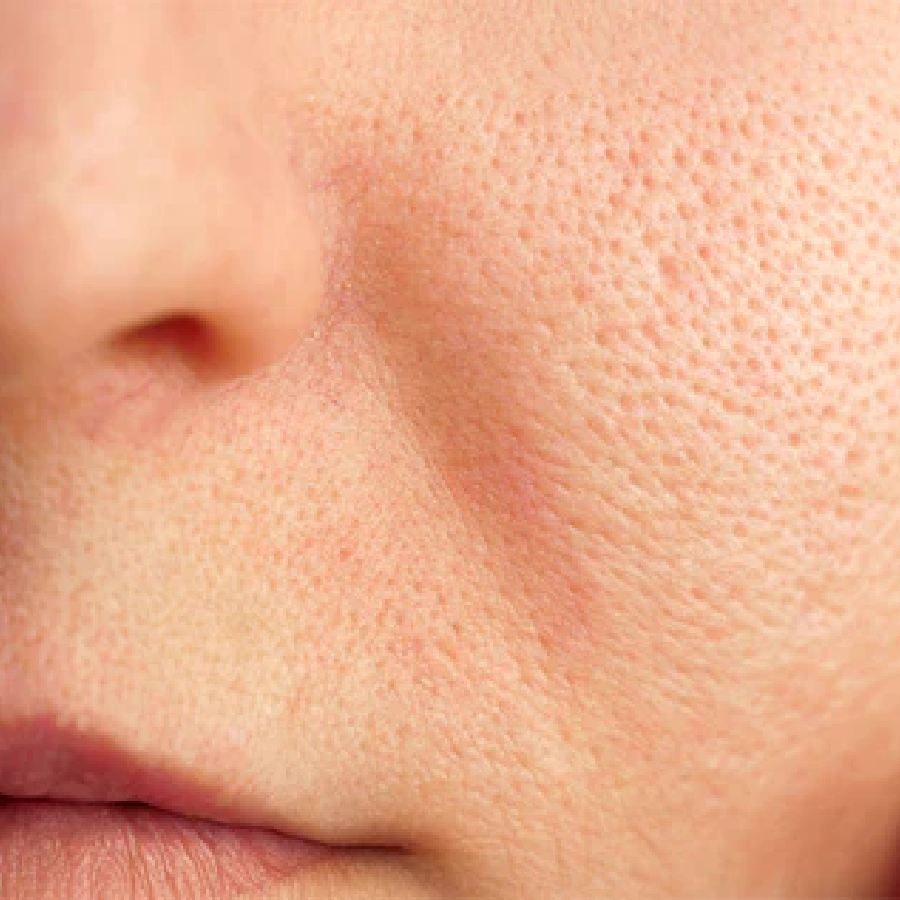 ত্বকের রন্ধ্রের প্রকৃতি কেমন?