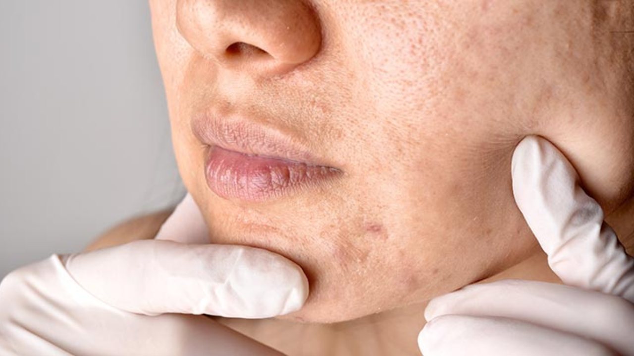 ত্বকের রন্ধ্রের প্রকৃতি কেমন?