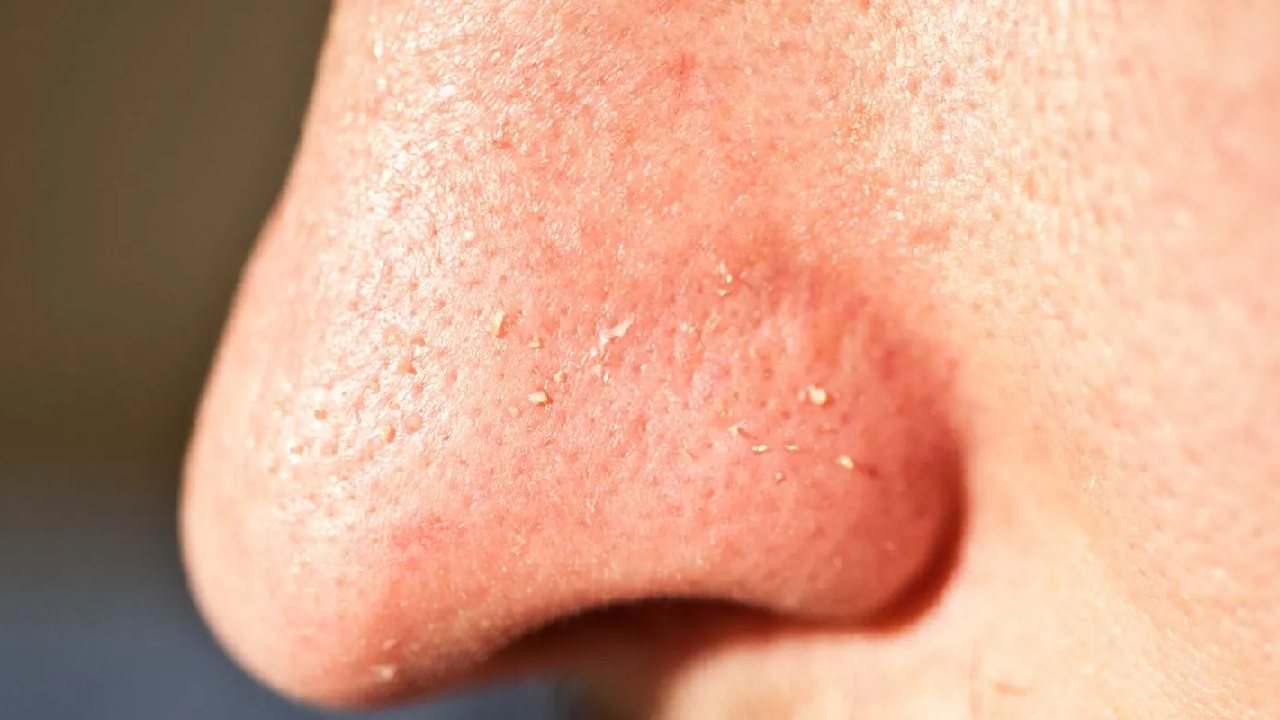 বন্ধ ছিদ্র।