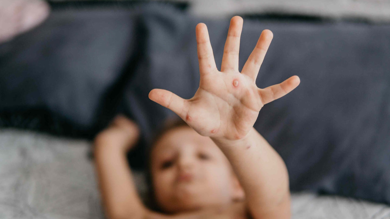 চিকেন পক্স ঠেকাতে কোন কোন খাবার খেতেই হবে?