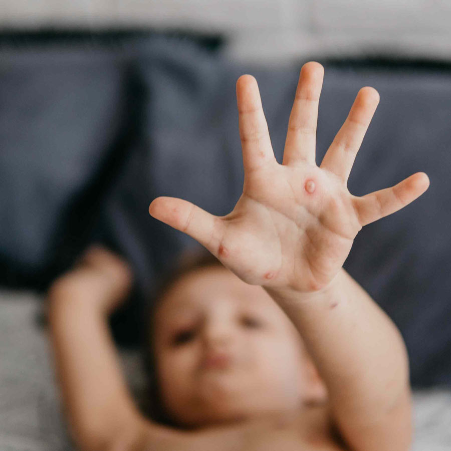 চিকেন পক্স ঠেকাতে কোন কোন খাবার খেতেই হবে?