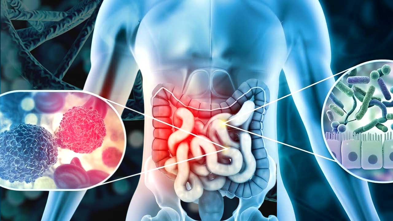 Scientists investigating rising cases of colorectal cancer in younger adults