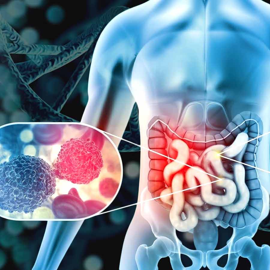 Scientists investigating rising cases of colorectal cancer in younger adults